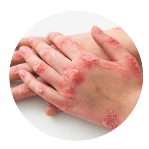 treatment  psoriasis  kerala india ayurvedic hospitals