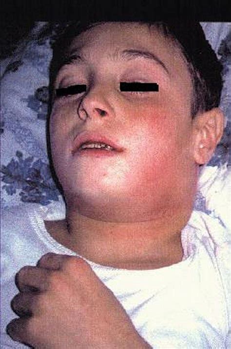 Image:Diphtheria (Nasopharyngeal With Bull Neck)-MSD Manual