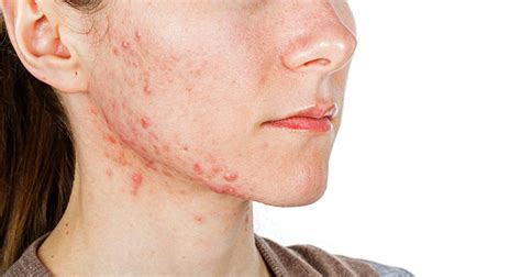 symptoms  skin problem   cure  treatment  skin problem