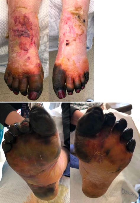 Abdominopelvic Amputation Transarterial Interventions In Civilian