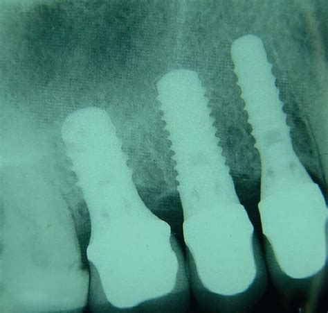 Planning for correct implant placement - The Dental Technician