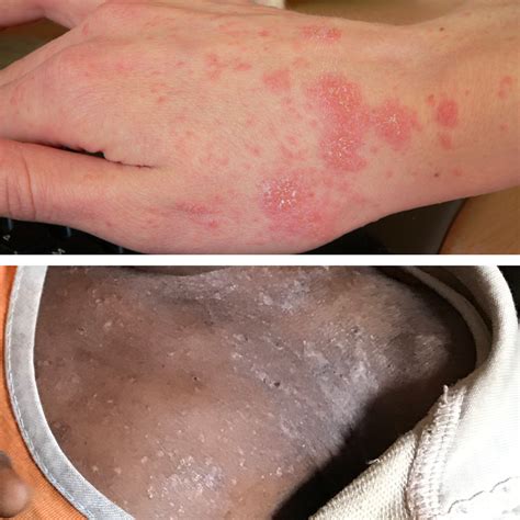 How To Identify Scabies Rash Scabies Rash Scabies Skin Rashes Pictures