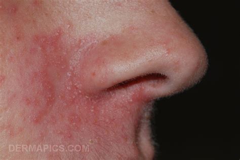 dermatitis - DriverLayer Search Engine