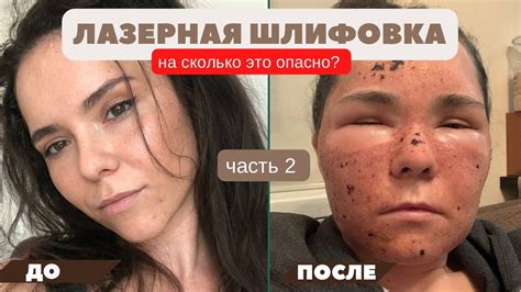 Лазерная шлифовка лица (ЧАСТЬ 2). Моя история. Лазер СО2. - YouTube