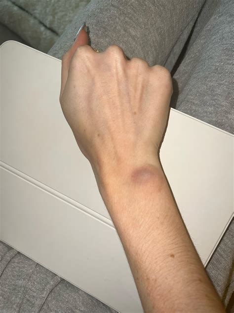 Bruise on wrist : r/RSI
