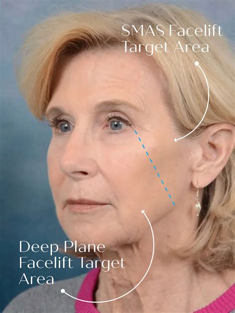 Deep Plane Facelift Scottsdale | Facelift Specialist in Scottsdale