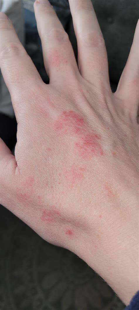Rash? : r/DermatologyQuestions