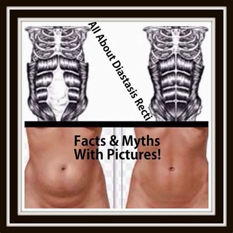 All About Diastasis Recti - Tons Of Facts & Myths Explained With ...