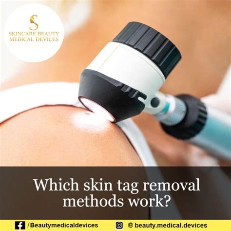 Which skin tag removal methods work? : Beauty, Skincare