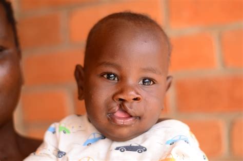 Operation Smile Malawi - Cleft Lip & Palate Children's Charity