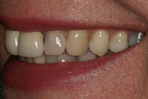 Crowns: Front Teeth - Smiles at France