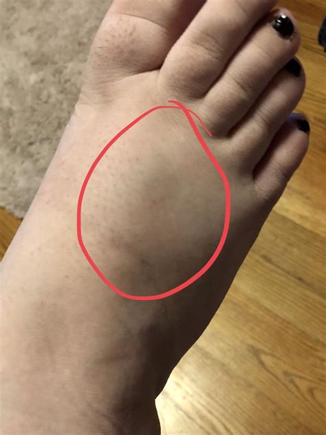 Swelling On Top Of Foot After Dropping Something On It Deals