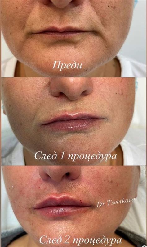 Поетапно изграждане на устни