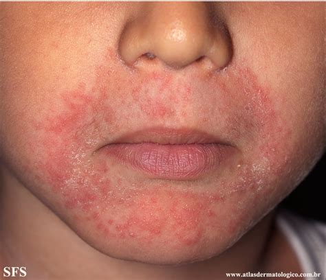 O Que É Dermatite Perioral
