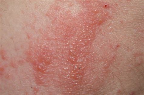 intertrigo rash pictures - pictures, photos