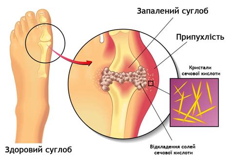 Подагра lyapko.ua - Аплікатори Ляпко