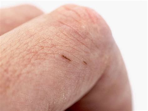 How to remove a splinter: Methods and tips
