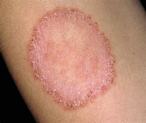 What is Ringworm and How to Identify It? - Speedy Sticks | Mobile Lab ...