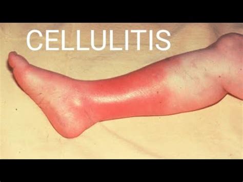 cellulitis skin infectioncellulitis  symptomsdiagnosis