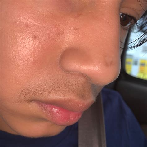 Bumps near eyes and nose - Beauty Insider Community