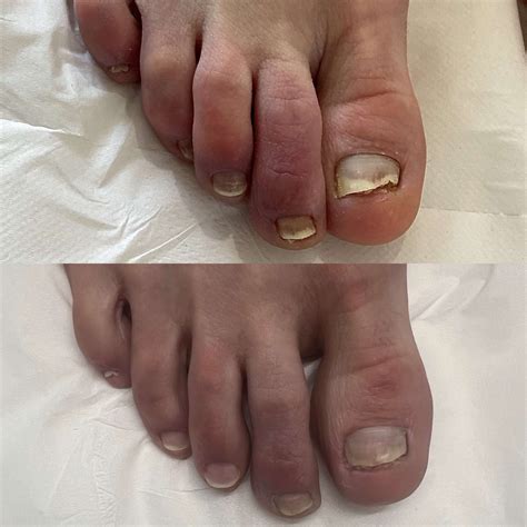 Fungal Nail Infections - Laser Loft