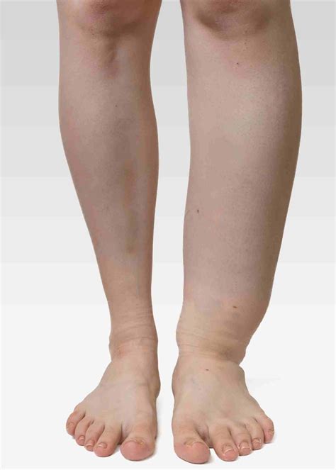 7 Ways to Treat Leg Lymphedema and Reduce Swelling - Cancer Rehab PT