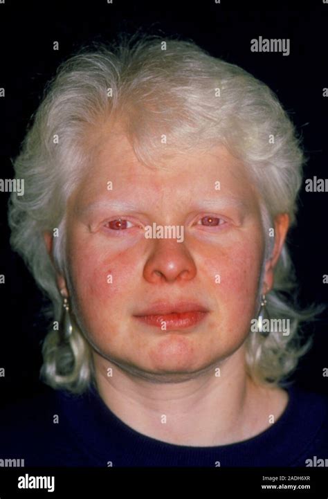 Albinism. Face of a 37-year-old woman with albinism. Albinism is a ...