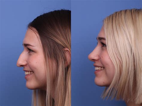 nose job    bump