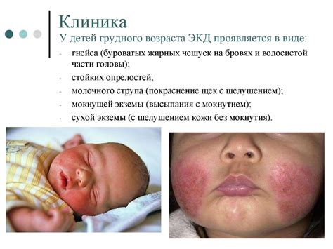 Аномалии конституции (диатезы) - online presentation