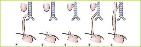 tof awareness week team evie