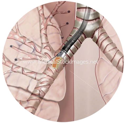 Endobronchial Ultrasound Procedure – Medical Stock Images Company