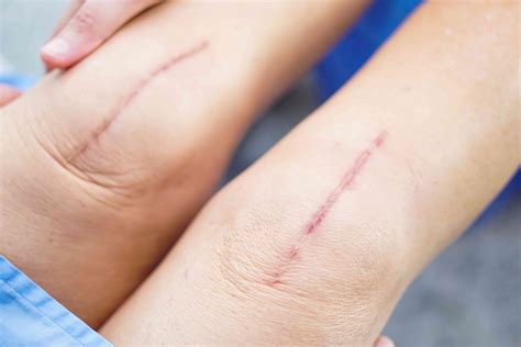 Scar Tissue Under Surgical Incision at Paul Osorio blog
