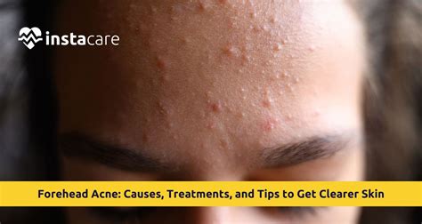 forehead acne  treatments tips  clear skin
