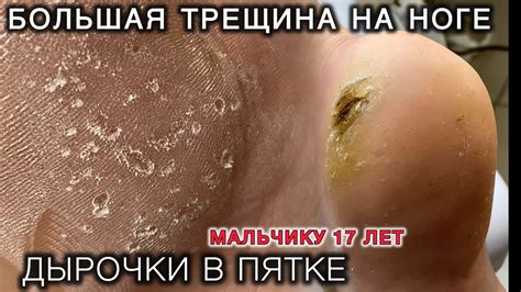 БОЛЬШАЯ ТРЕЩИНА НА ПЯТКАХ - СТРАННЫЕ ДЫРКИ НА СТОПЕ что делать? # ...