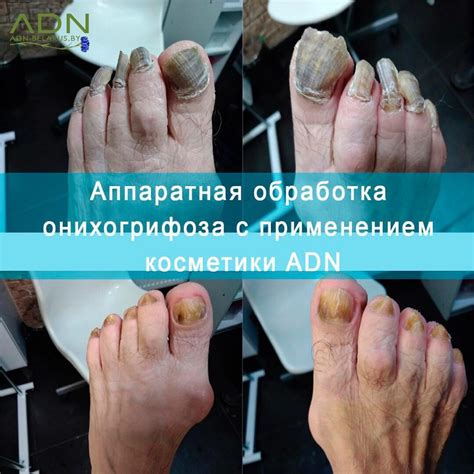 Аппаратная обработка онихогрифоза с применением косметики ADN ...