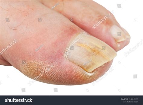 Topical Antifungal Treatment Seen Big Toe Stock Photo 2188261775 ...