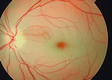 Central retinal artery occlusion - Wikipedia