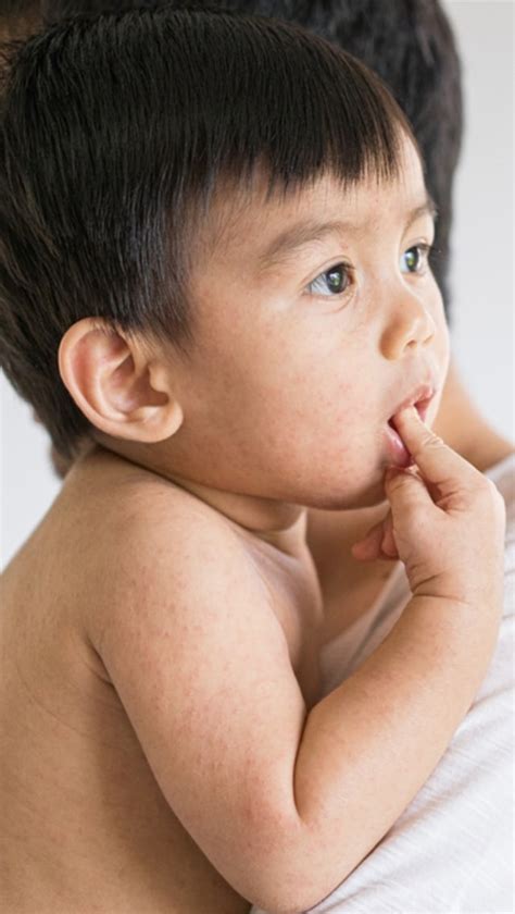 ruam merah muncul  kulit anak setelah demam bahaya enggak ya