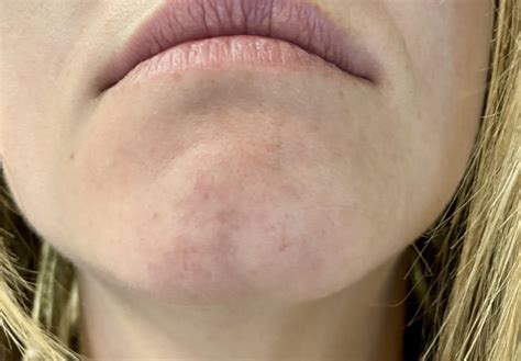 [Skin Concerns] Clogged pores in chin and nose that appear like “yellow
