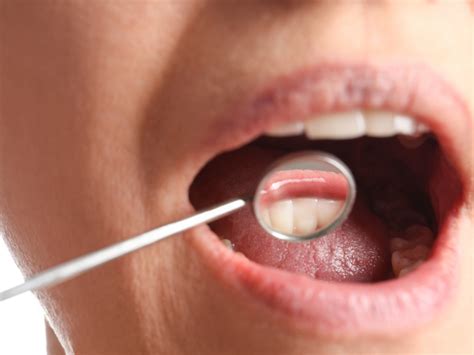 5 Stages of Periodontal Disease