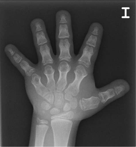 Hand of a patient with acrodysostosis and multihormonal resistance ...