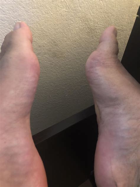 Gout in both my big toes! : r/gout