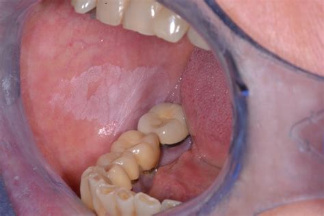 Leucoplasia Oral – OPMDCARE