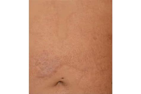 Les cicatrices : causes et traitements | Clinique Skin Marceau | Paris