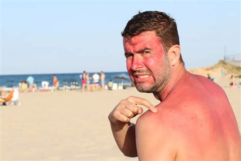treat  severe sunburn emergency medicine urgent care