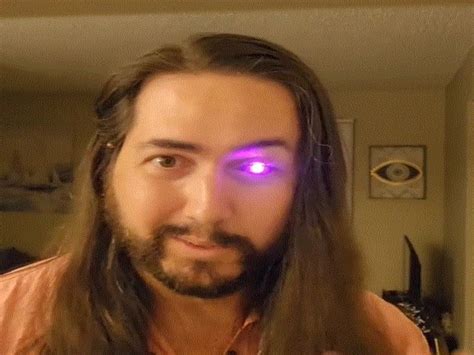 US Man Loses Eye To Cancer Creates Prosthetic Eye With A Flashlight