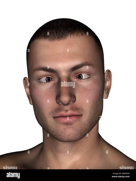 Esotropia - 3D render Stock Photo - Alamy