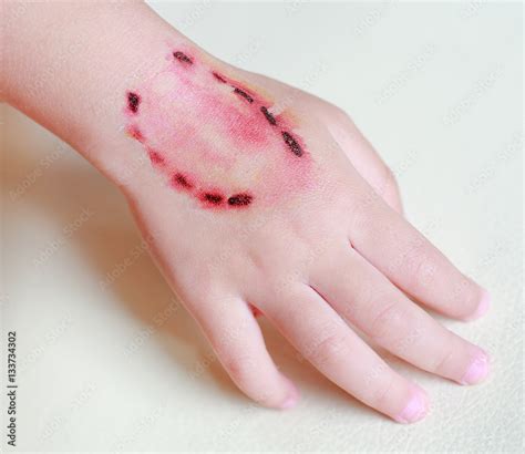 sticker wound  blood   bite human teeth  child hand dress