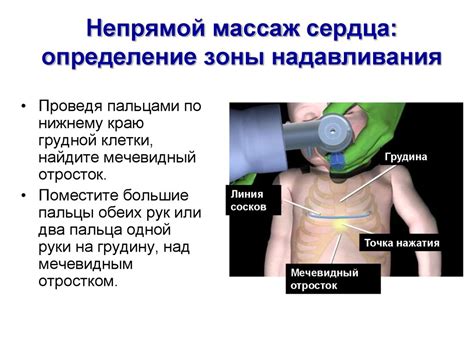 Непрямой массаж сердца - презентация онлайн