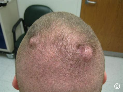 epidermoid cyst scalp